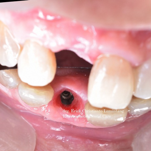gigi implant (1)