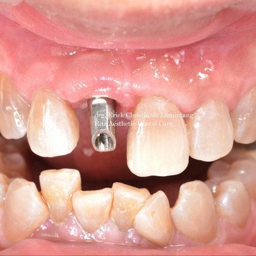 gigi implant (2)