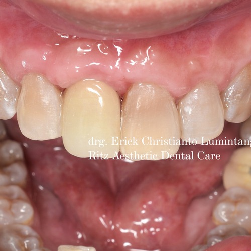 gigi implant (3)