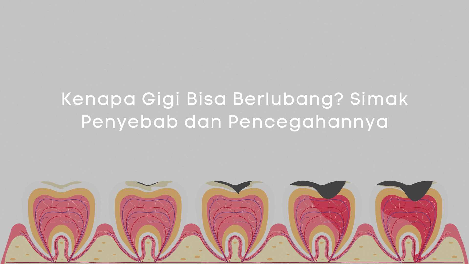 Kenapa Gigi Bisa Berlubang Simak Penyebab dan Pencegahannya