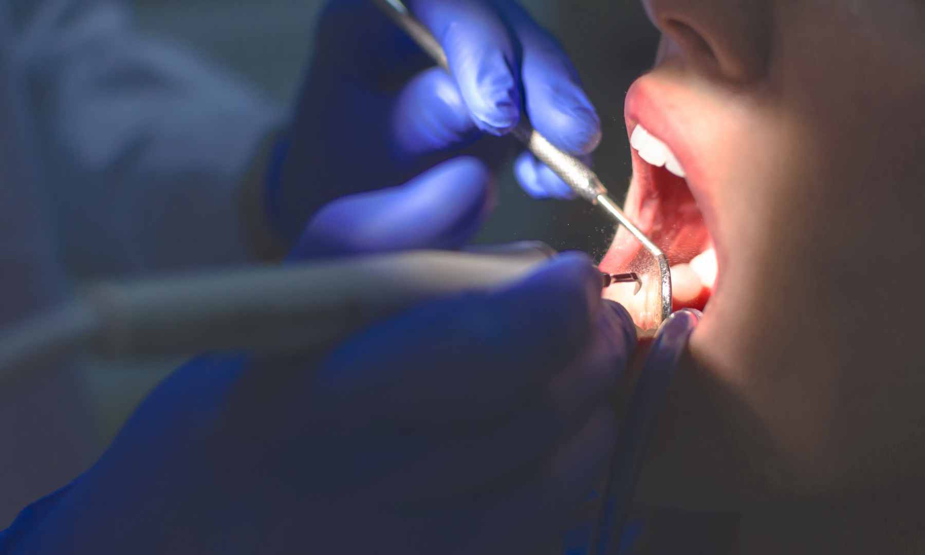 Seberapa Sering Harus ke Dokter Gigi? Cek Panduan Rutinnya